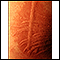 Dermatographism - close-up