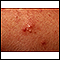 Acne - close-up of pustular lesions