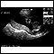 Ultrasound, normal relaxed placenta