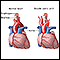 Double aortic arch