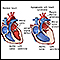 Hypoplastic left heart syndrome