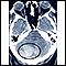 Intracerebellar hemorrhage - CT scan