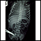 Totally anomalous pulmonary venous return - X-ray