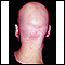 Alopecia totalis - back view of the head