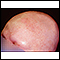 Alopecia totalis - front view of the head