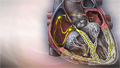 Atrial fibrillation