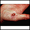 Pyogenic granuloma on the hand