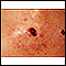 Skin cancer - close-up of level IV melanoma