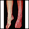 Sturge-Weber syndrome - legs