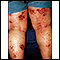 Dermatitis - atopic on the legs