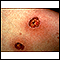 Ecthyma gangrenosum