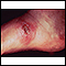 Leishmania panamensis on the foot