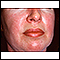 Dermatomyositis - heliotrope rash on the face