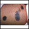 Congenital nevus on the abdomen