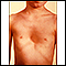 Pectus excavatum