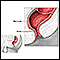 Hemorrhoid surgery  - series