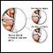 Medial collateral ligament injury