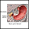 Pyloric stenosis