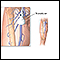 Doppler ultrasonography of an extremity