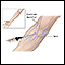 Intravenous pyelogram