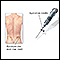 Bone biopsy