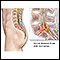 Spinal stenosis